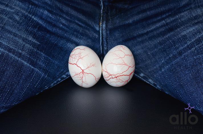 White eggs - a symbol of man's balls. varicocele - male disease leading to infertility in men. the concept of risk urological diseases. Varicose veins on the testicles. Can varicocele cause ed

Do Testicles Shrink After Ejaculation? 