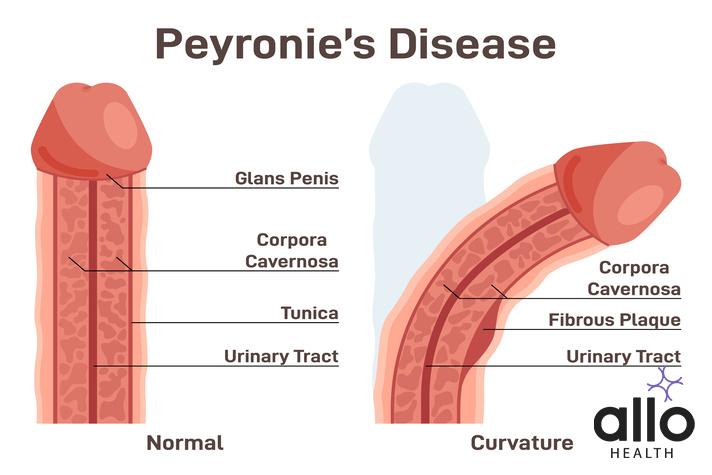 What Is Peyronies Disease?
Peyronie's disease. Fibrous scar tissue developing under the skin of the penis and causing a curve. Male organ' incorrect form. Flat vector illustration