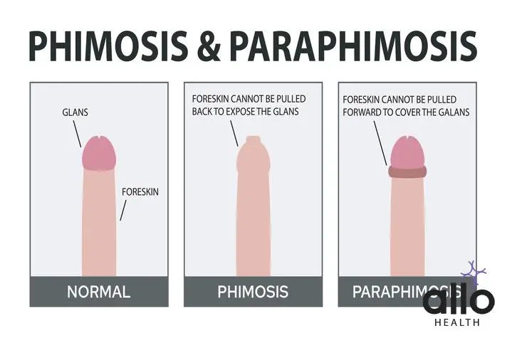 Phimosis: Causes, Diagnosis & Treatment - India IVF