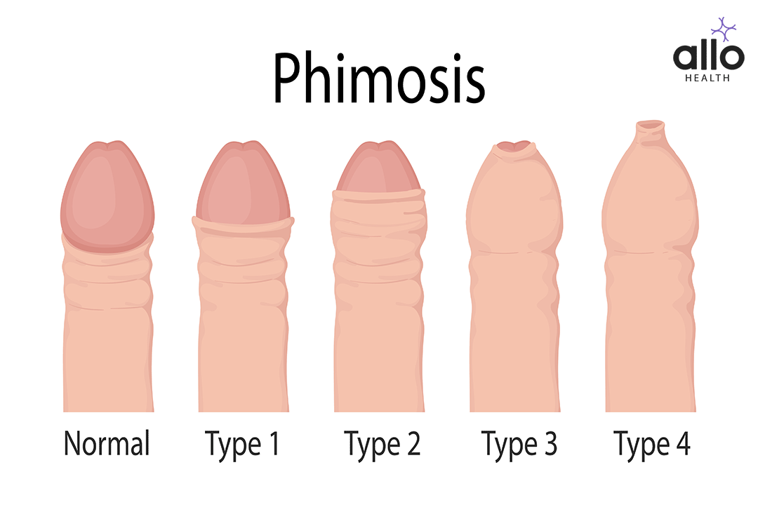 Diagnosis of phimosis
Phimosis Treatment
