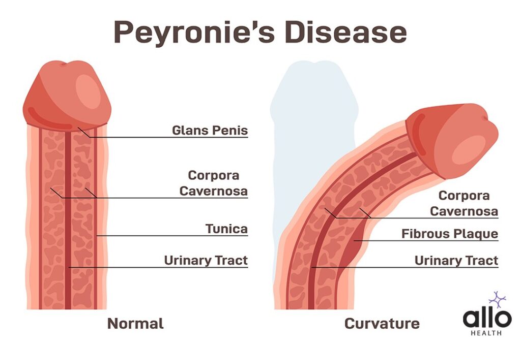 Peyronies Disease 1 Diagnosis of Paraphimosis Disease