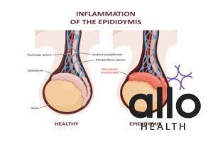 Does Epididymitis Cause Premature Ejaculation? 