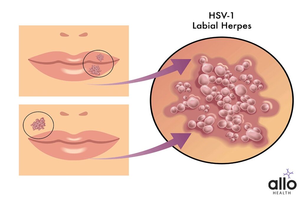 Herpes Simplex Virus Type 1 (HSV-1)