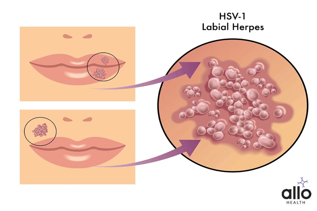 What Is Herpes? 1 Herpes Simplex Virus Type 1 (HSV-1)
