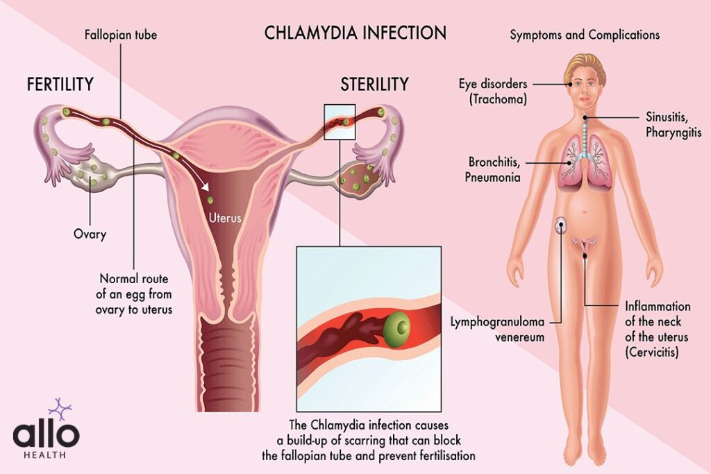 Types of Chlamydia