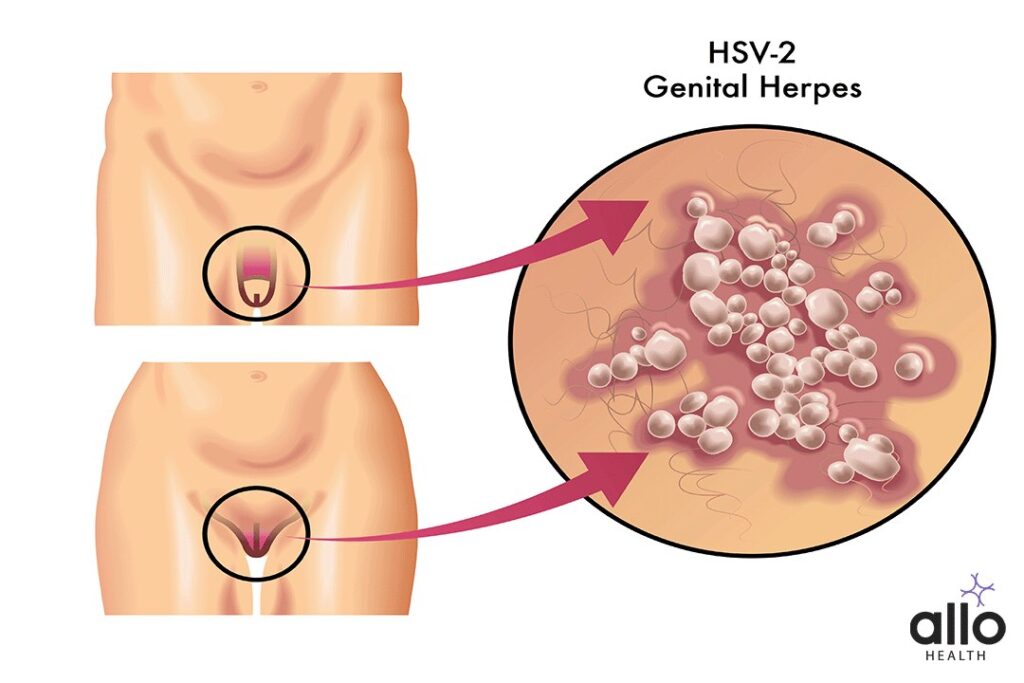What Is Herpes? 2 Herpes Simplex Virus Type 2 (HSV-2). herpes simplex virus in hindi
