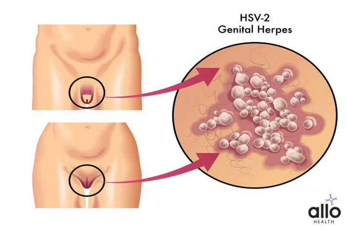 Herpes Simplex Virus Type 2 (HSV-2). herpes simplex virus in hindi
