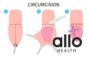 Circumcision