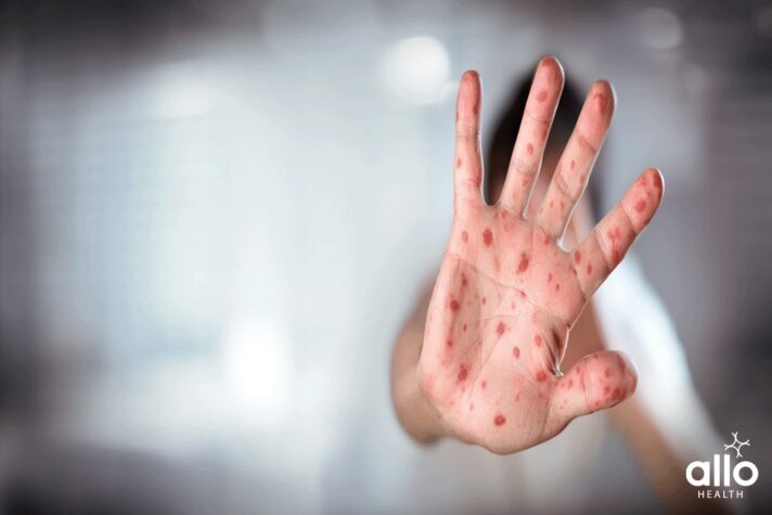 Shingles vaccine