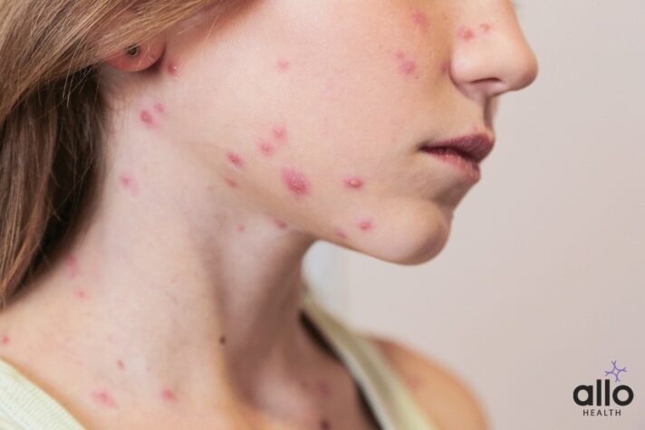 FQA on Shingles Vaccine - Viral Diseases With face Infected