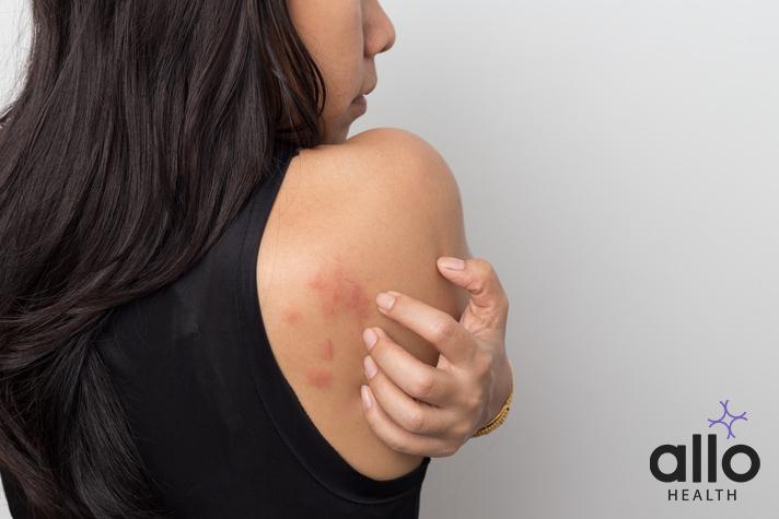 woman showing her skin itching behind , with allergy rash urticaria symptoms. eczema meaning in hindi, premature ejaculation cream