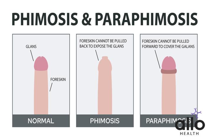 Can A Man With Phimosis Make A Woman Pregnant?

What Is Paraphimosis Treatment Cream?