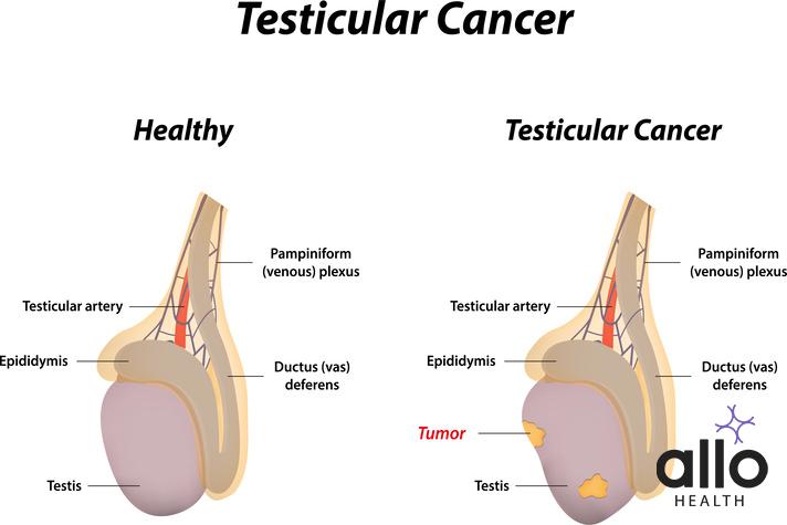 Does Masturbation Cause Testicular Cancer?