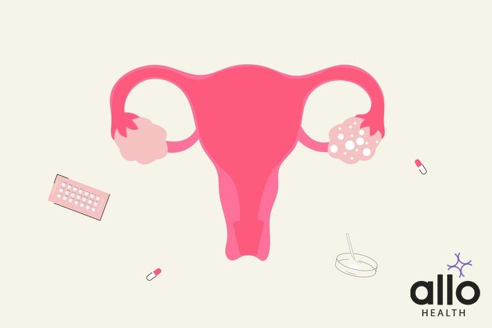 Polycystic Ovary Syndrome, Bacterial Vaginosis (BV) Effective Treatment Options