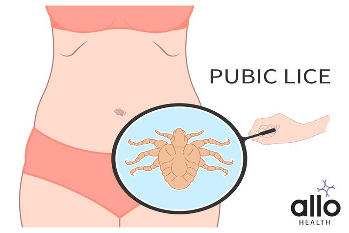 Scabies And Crabs: Causes, Treatments & Prevention